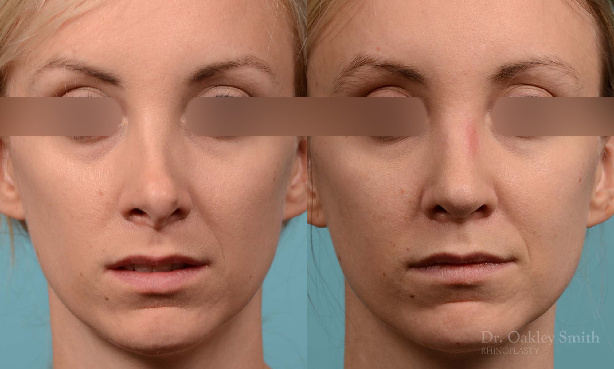 Rhinoplasty - Rhinoplasty Before and After Case 280