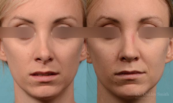 Rhinoplasty - Rhinoplasty Before and After Case 280