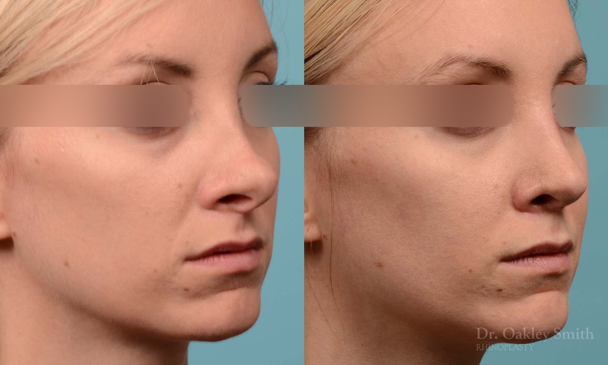 Female bridge rhinoplasty