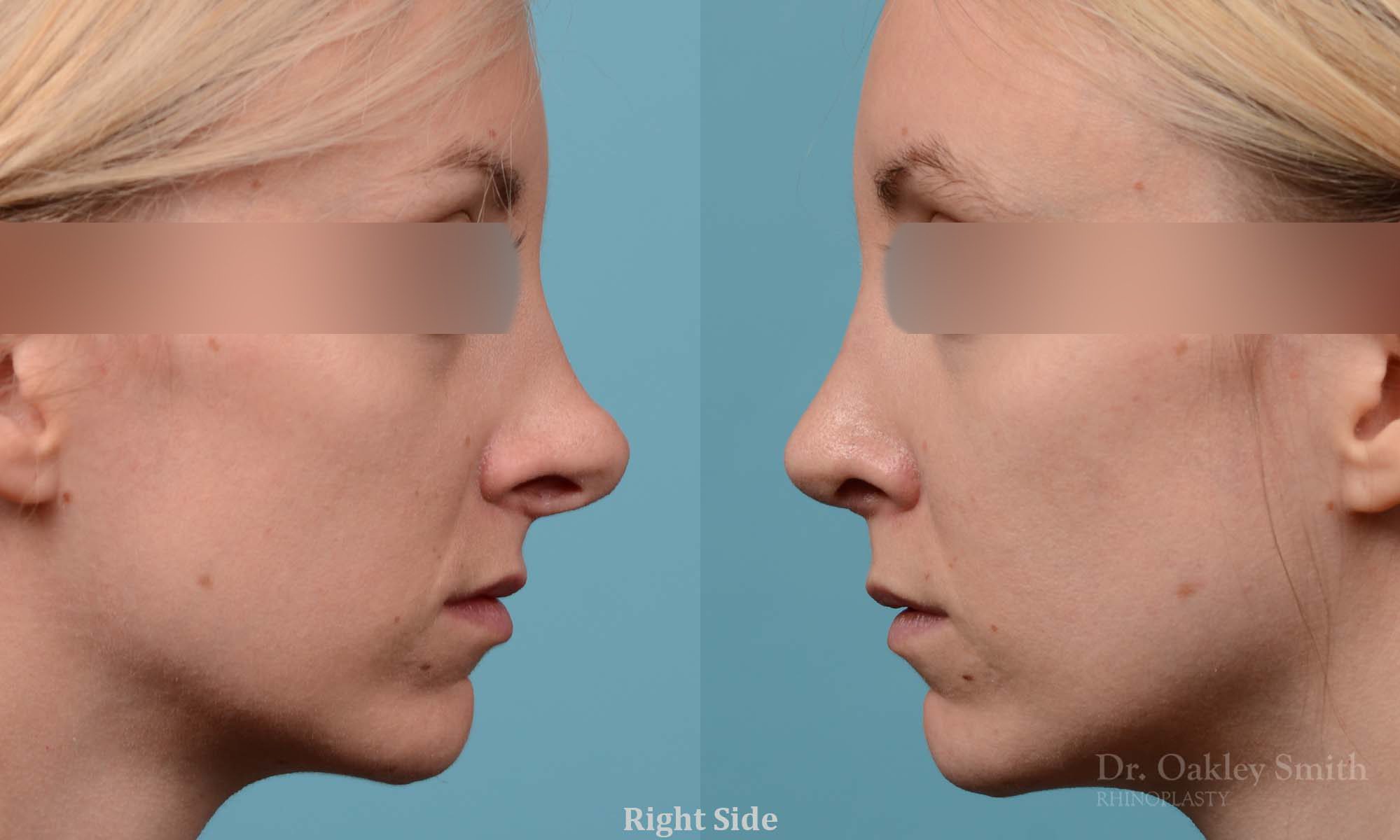 Female bridge rhinoplasty