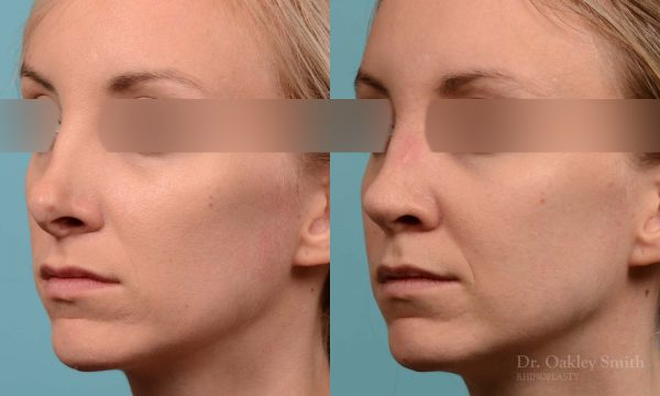 Female bridge rhinoplasty