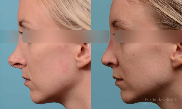 Female bridge rhinoplasty