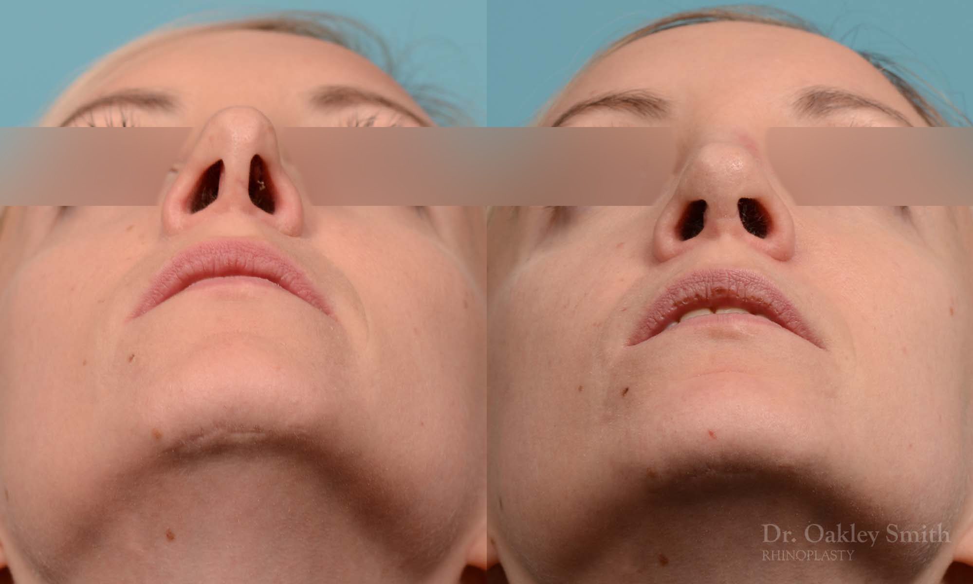 Female bridge rhinoplasty