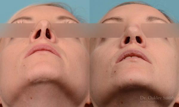 Female bridge rhinoplasty