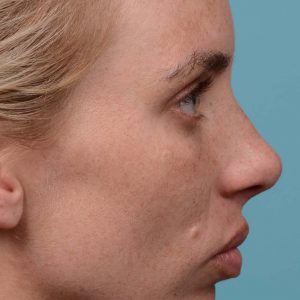 Female rhinoplasty, breathing