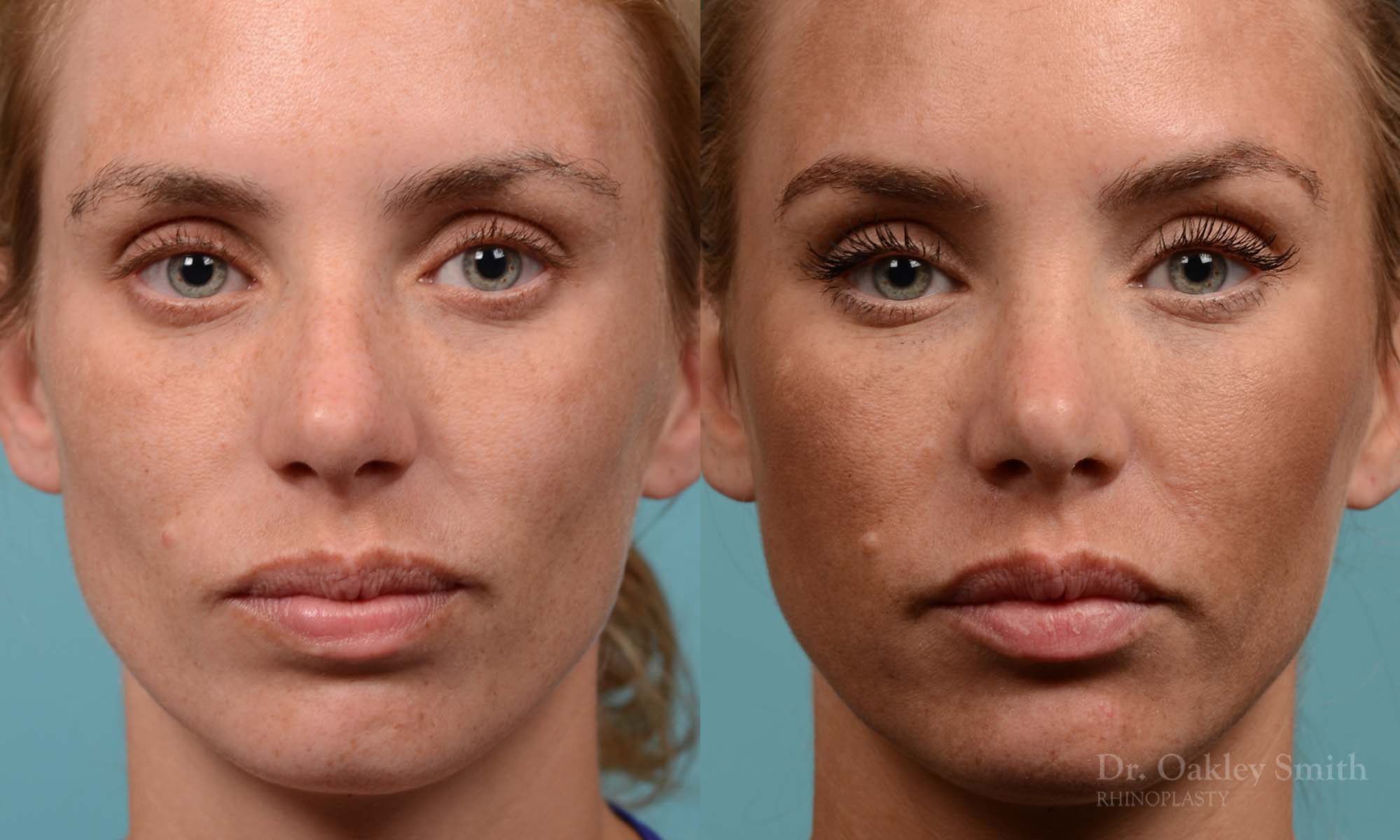 Female rhinoplasty, breathing