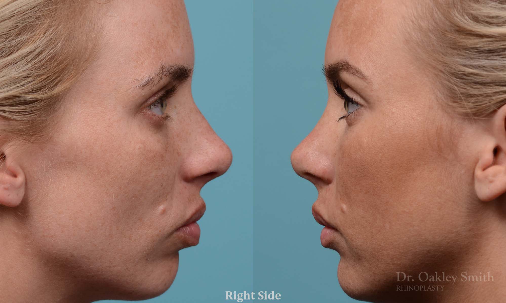Female rhinoplasty, breathing