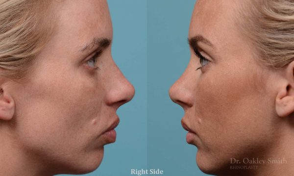 Female rhinoplasty, breathing