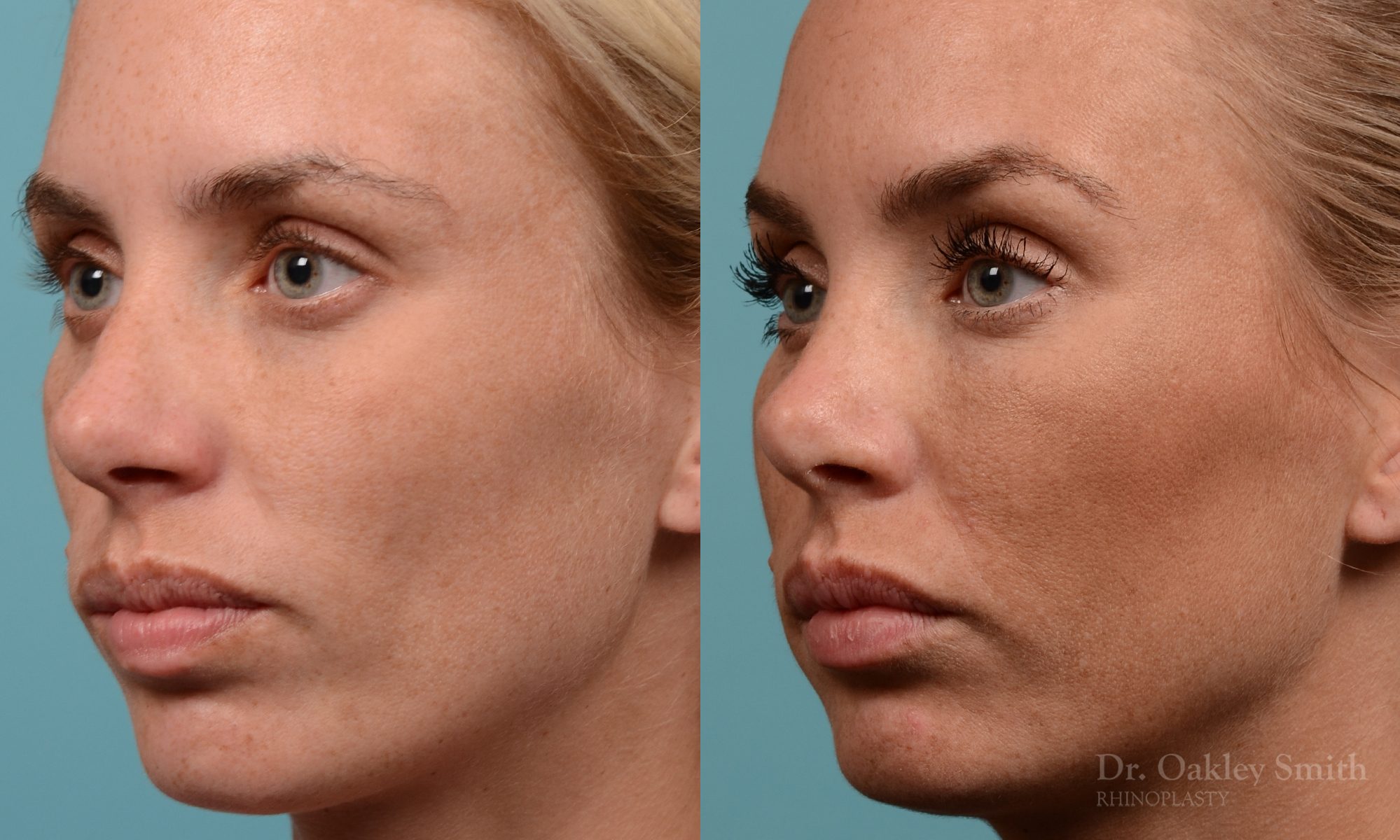 Female rhinoplasty, breathing