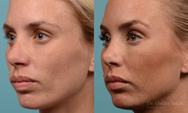 Female rhinoplasty, breathing