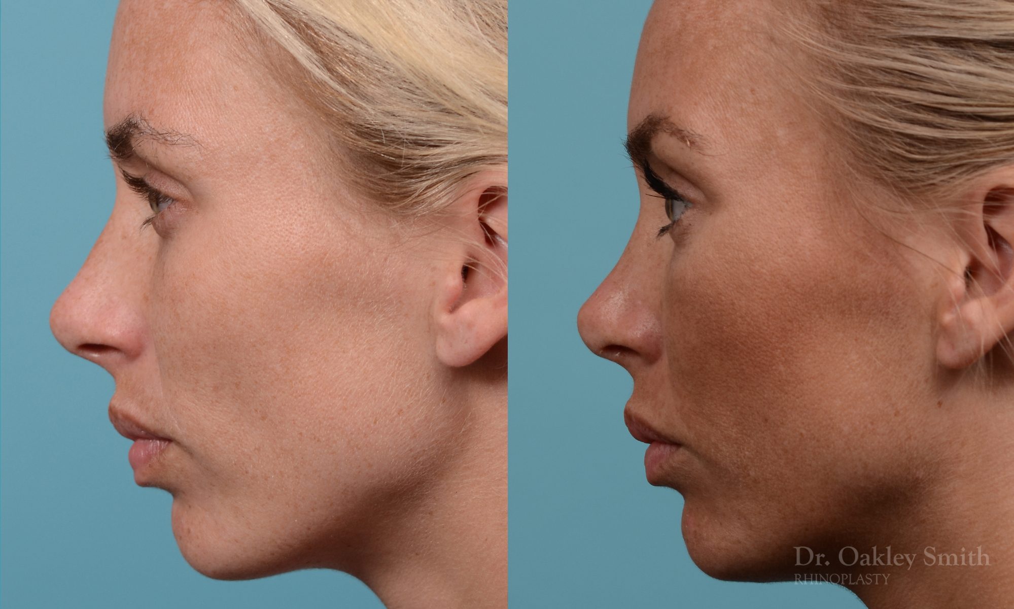 Female rhinoplasty, breathing