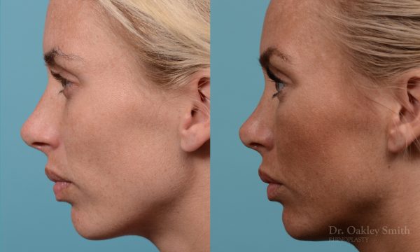 Female rhinoplasty, breathing