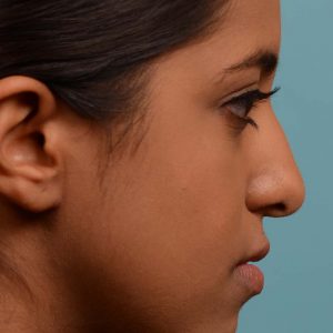 Younge female rhinoplasty.