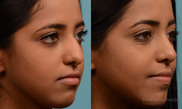 Younge female rhinoplasty.