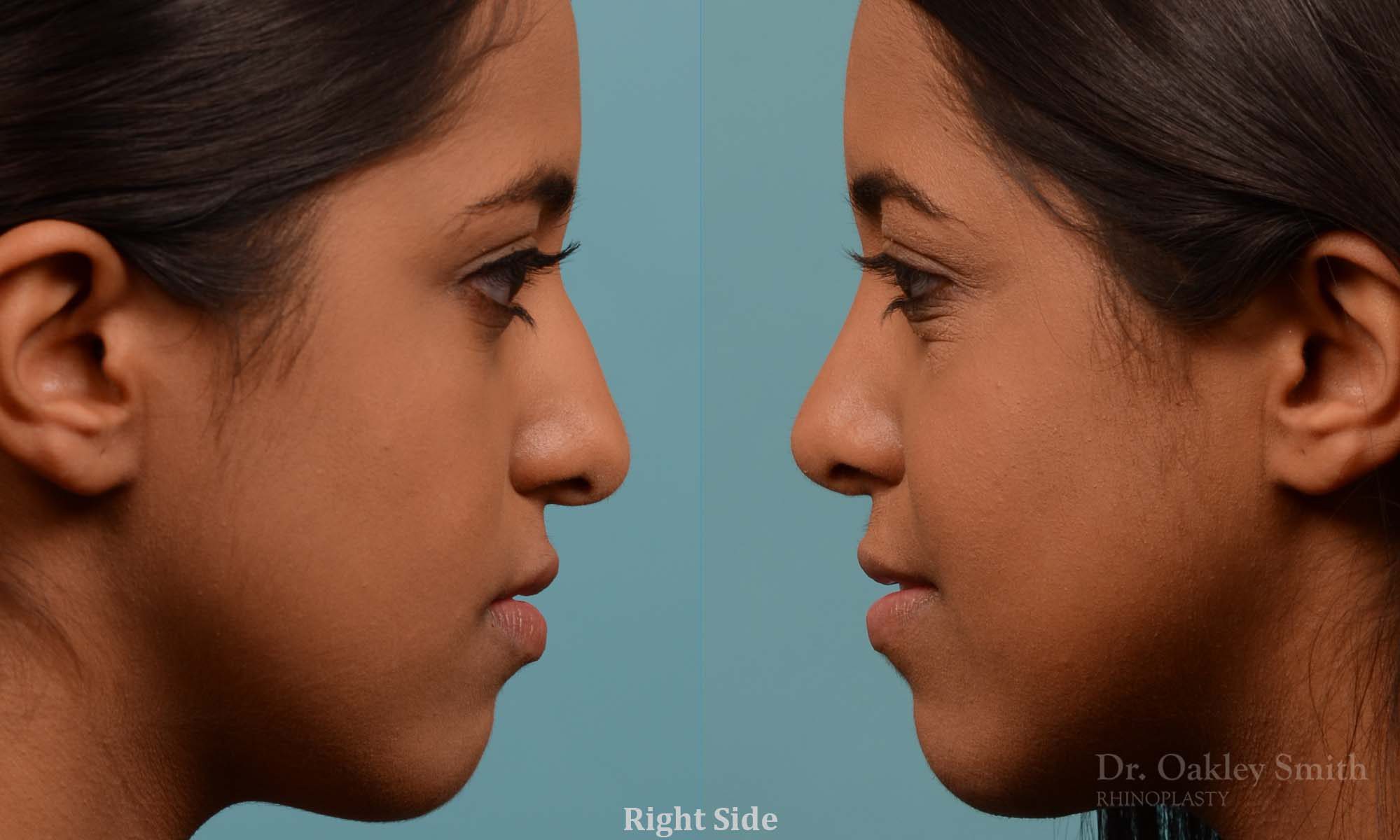 Younge female rhinoplasty.
