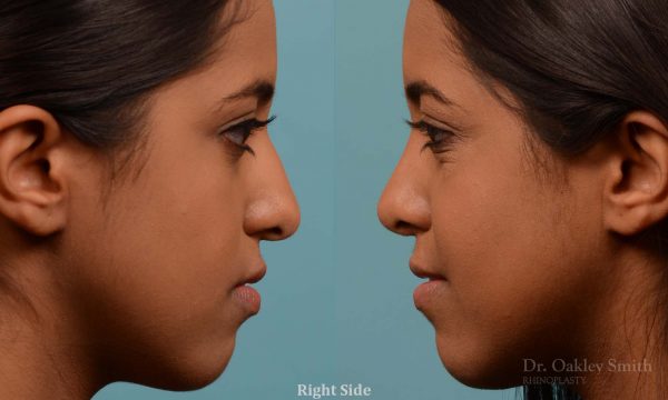 Younge female rhinoplasty.