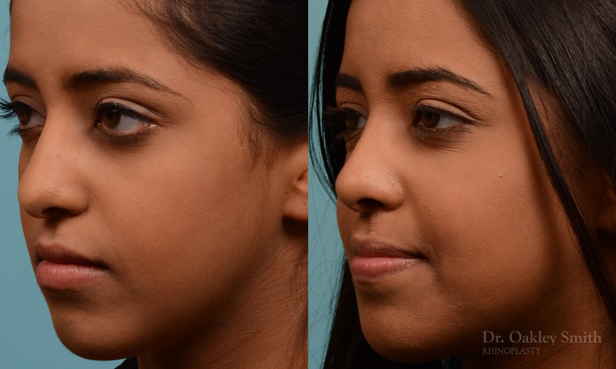 Younge female rhinoplasty.