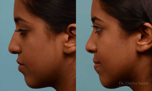 Younge female rhinoplasty.
