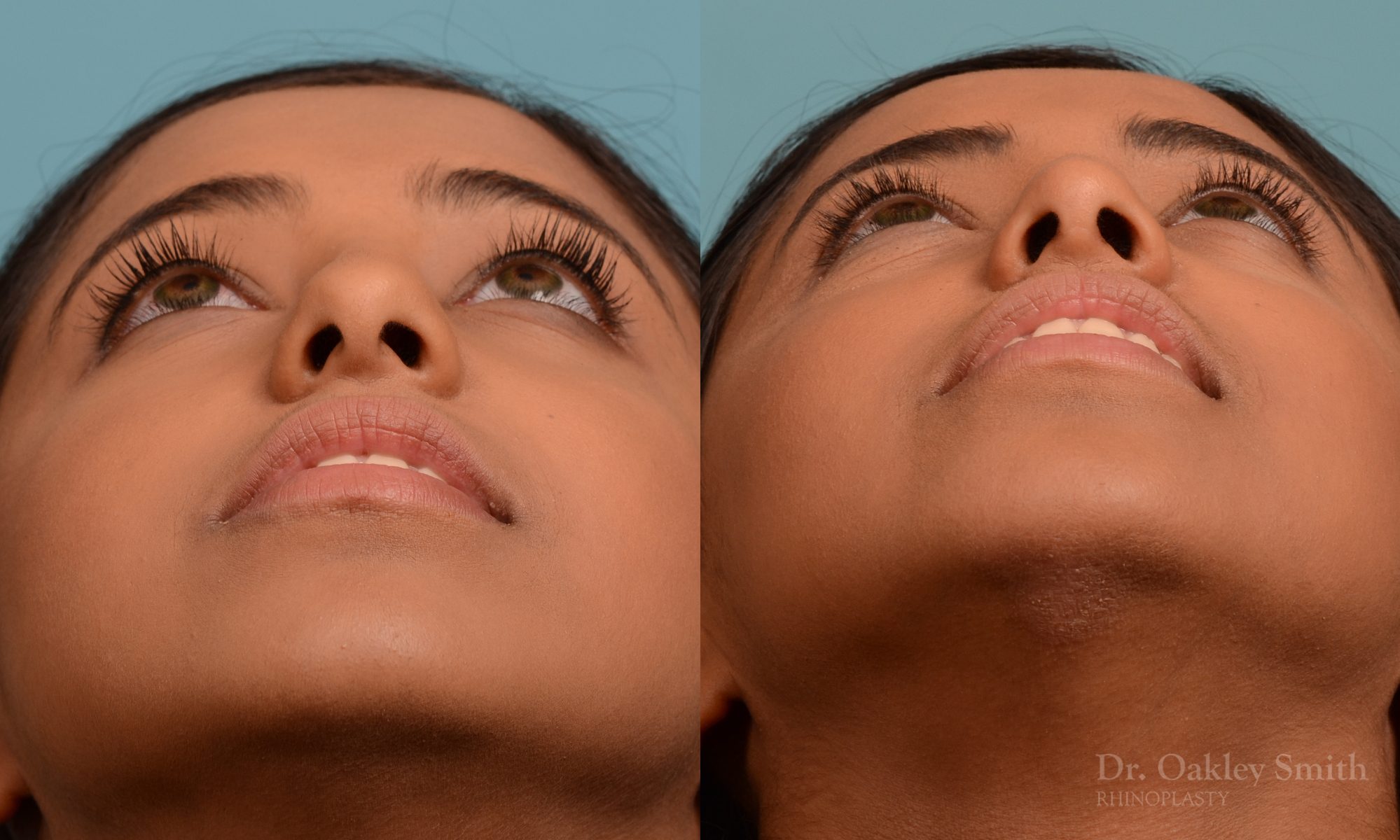 Younge female rhinoplasty.