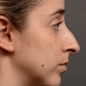 Rhinoplasty hump reduction