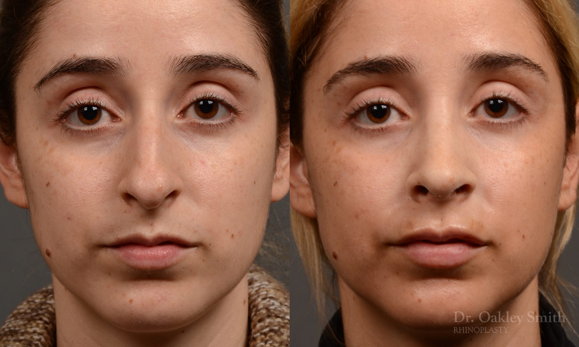 Rhinoplasty hump reduction