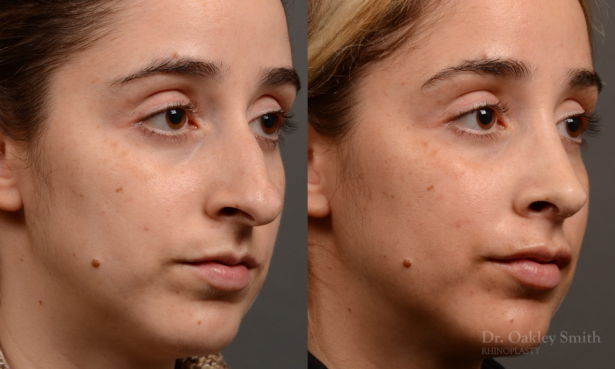Rhinoplasty hump reduction