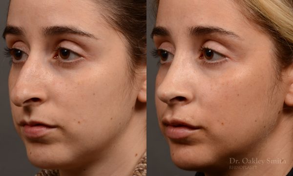 Rhinoplasty hump reduction
