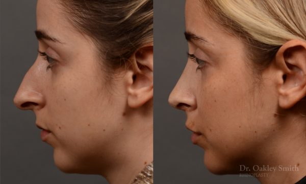 Rhinoplasty hump reduction