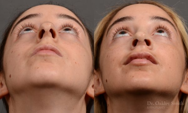 Rhinoplasty hump reduction