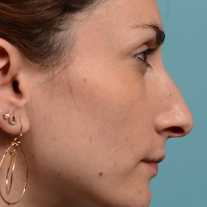 Female rhinoplasty hump reduction