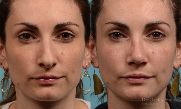 Female rhinoplasty hump reduction