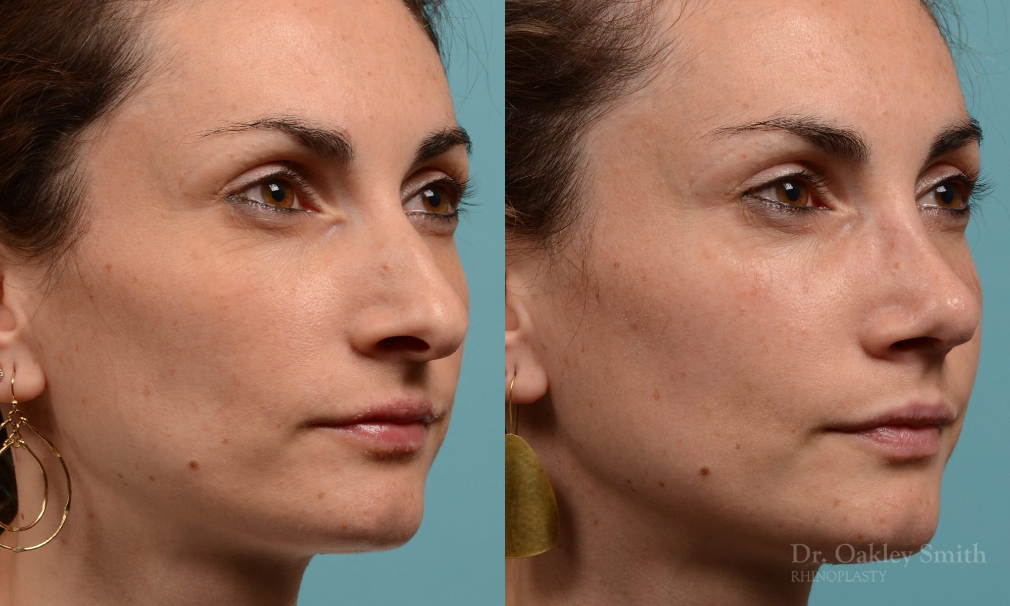 Female rhinoplasty hump reduction