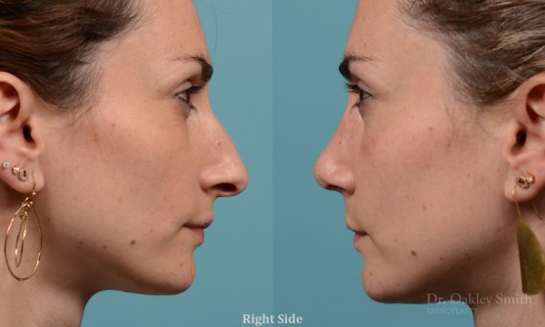 Female rhinoplasty hump reduction