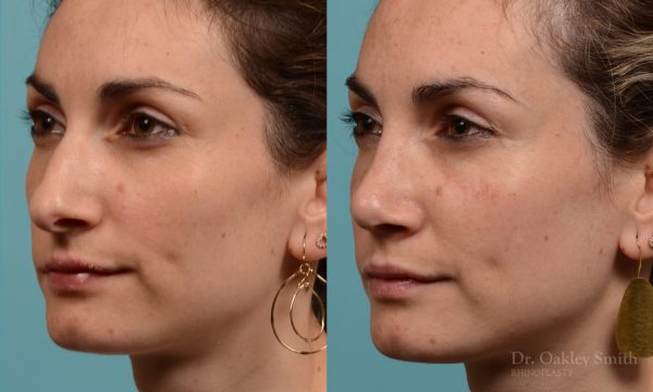 Female rhinoplasty hump reduction