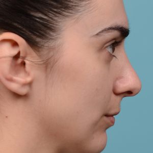 Revision rhinoplasty