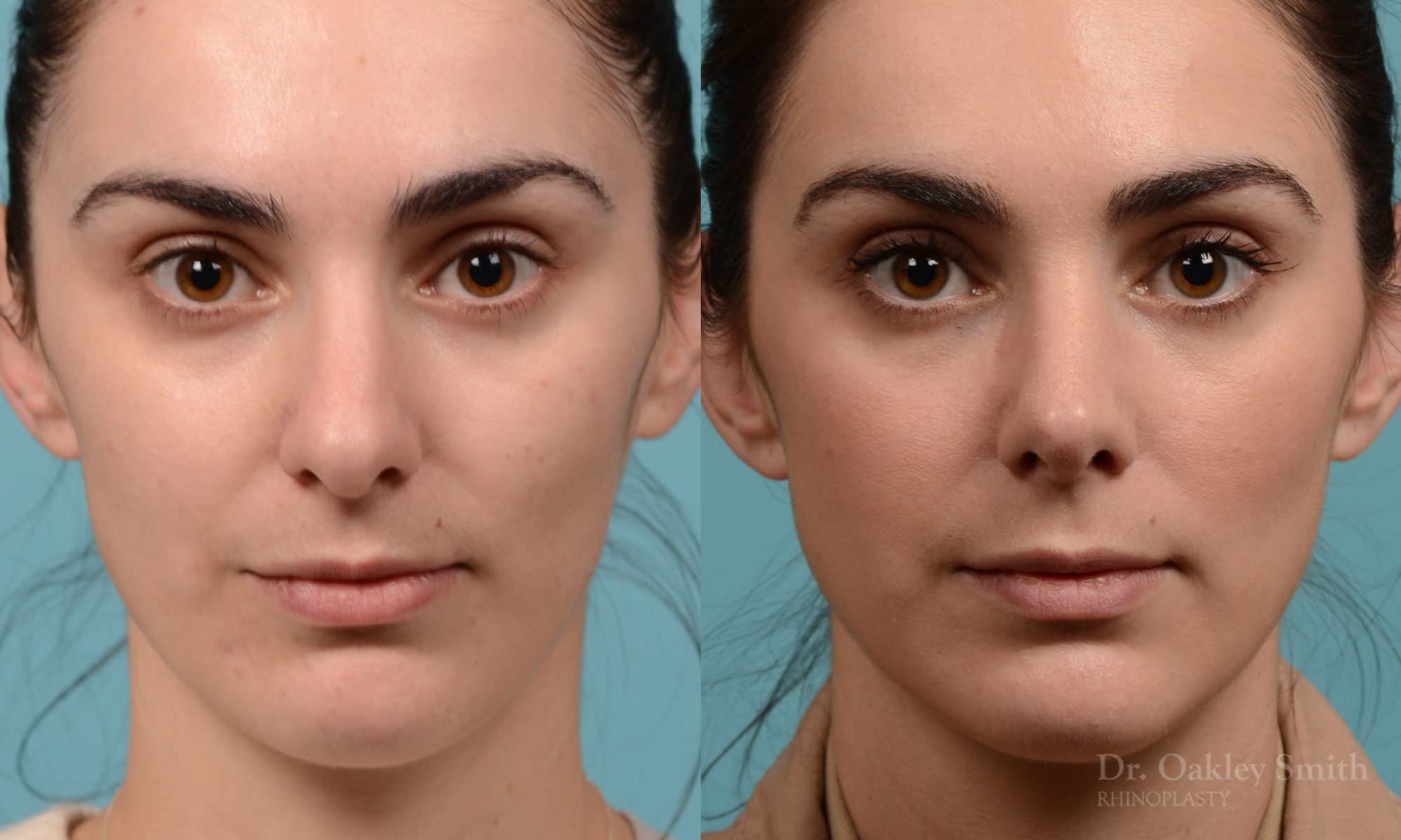 Revision rhinoplasty
