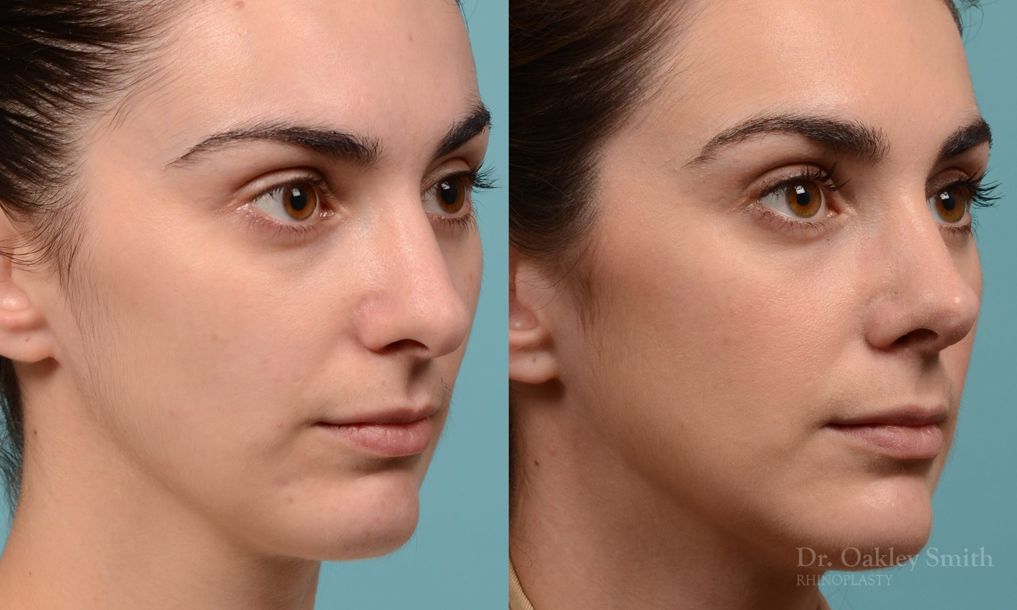 Revision rhinoplasty