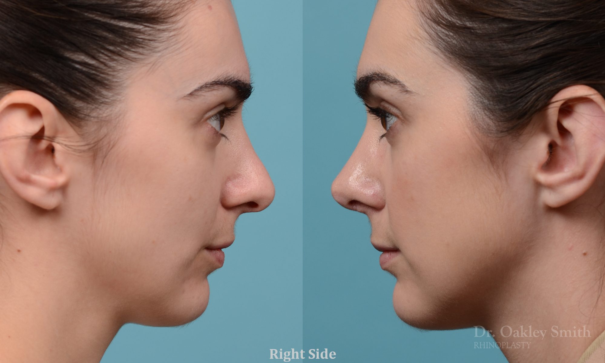 Revision rhinoplasty