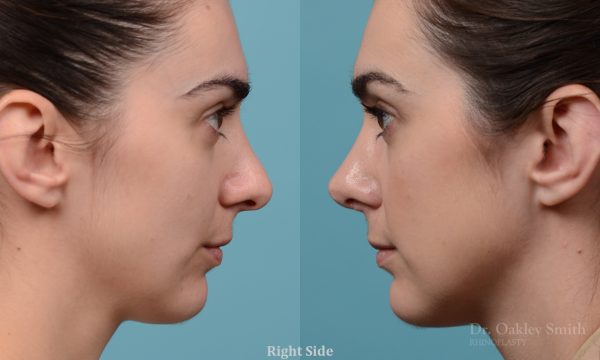Revision rhinoplasty