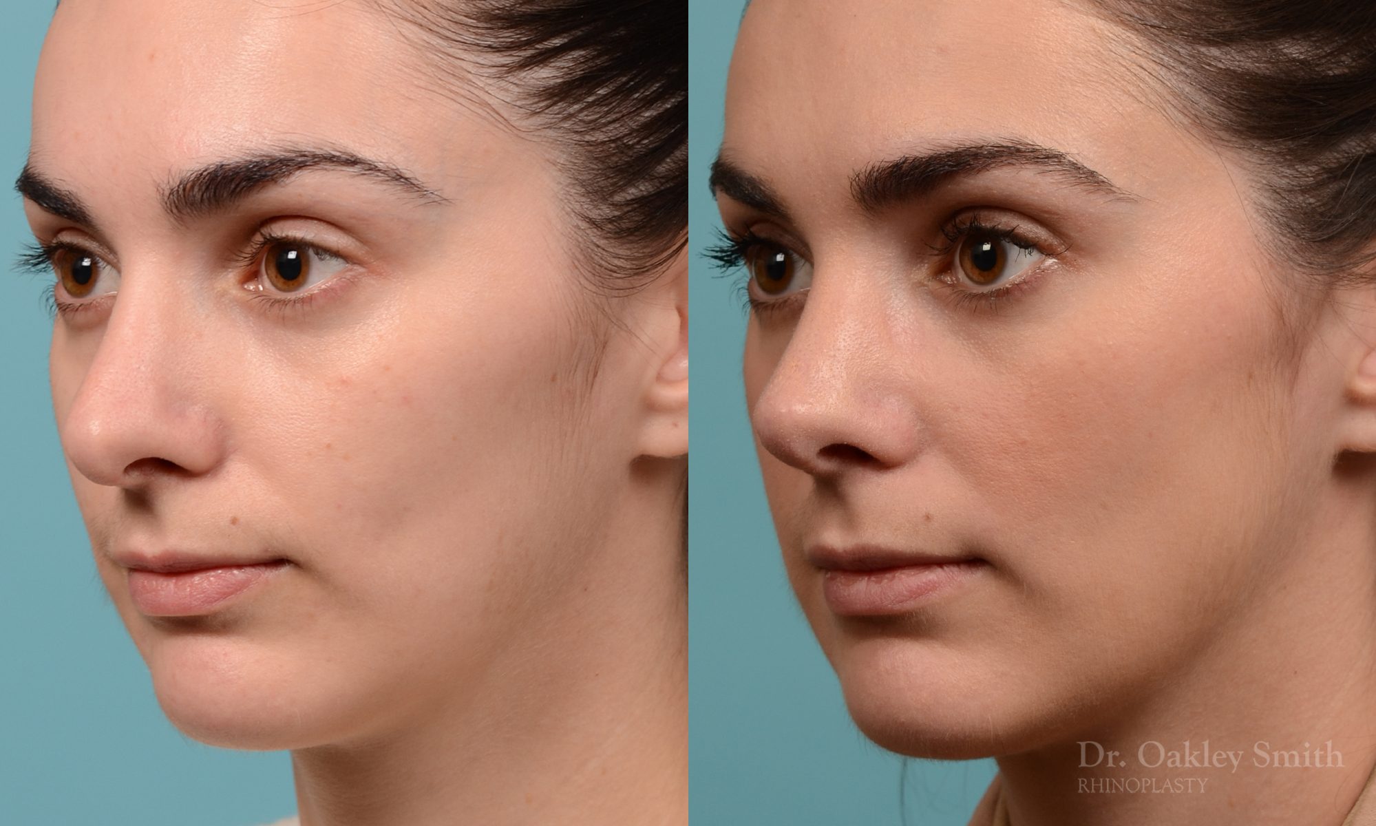 Revision rhinoplasty