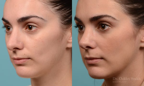 Revision rhinoplasty