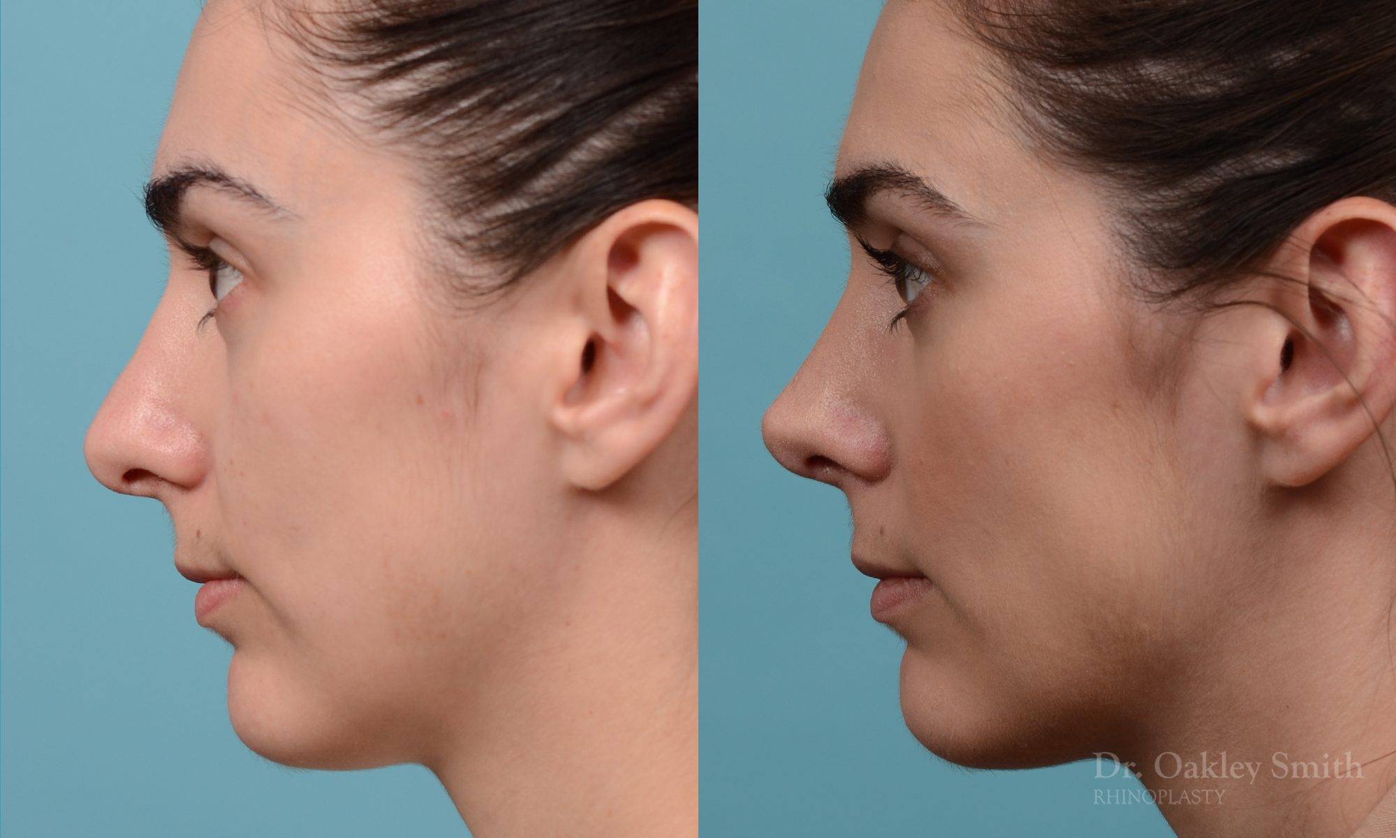 Revision rhinoplasty