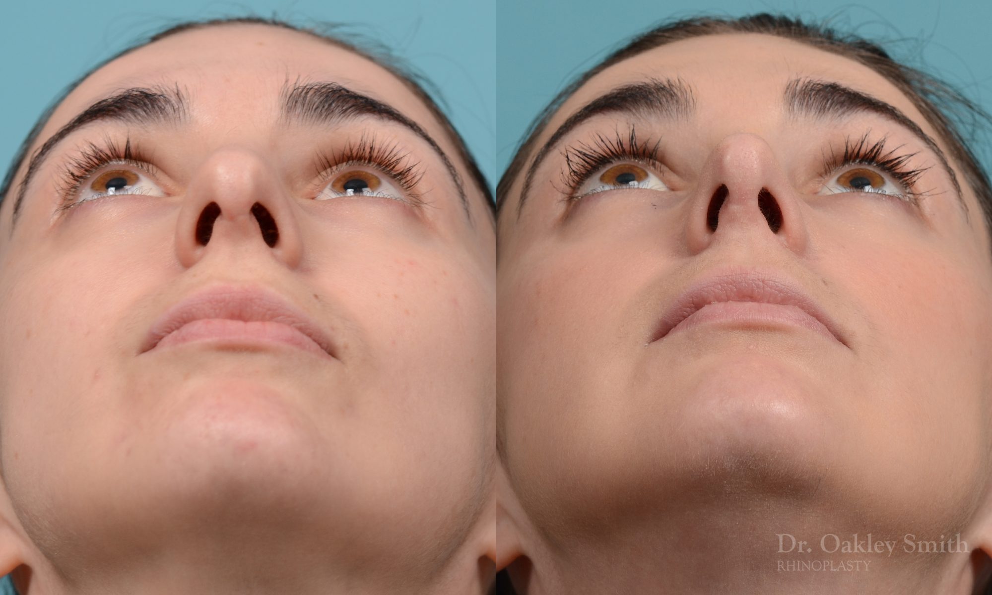 Revision rhinoplasty
