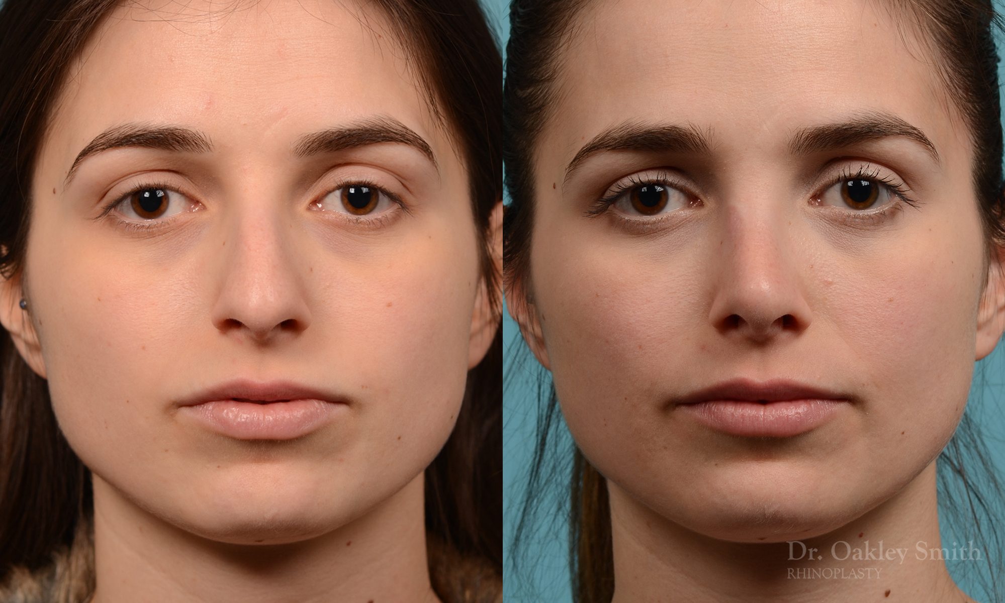 Severe rhinoplasty with hump reduction