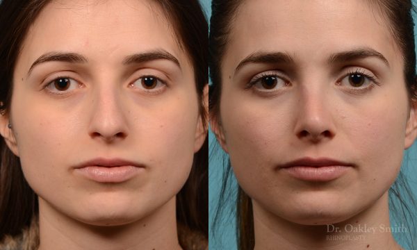 Severe rhinoplasty with hump reduction