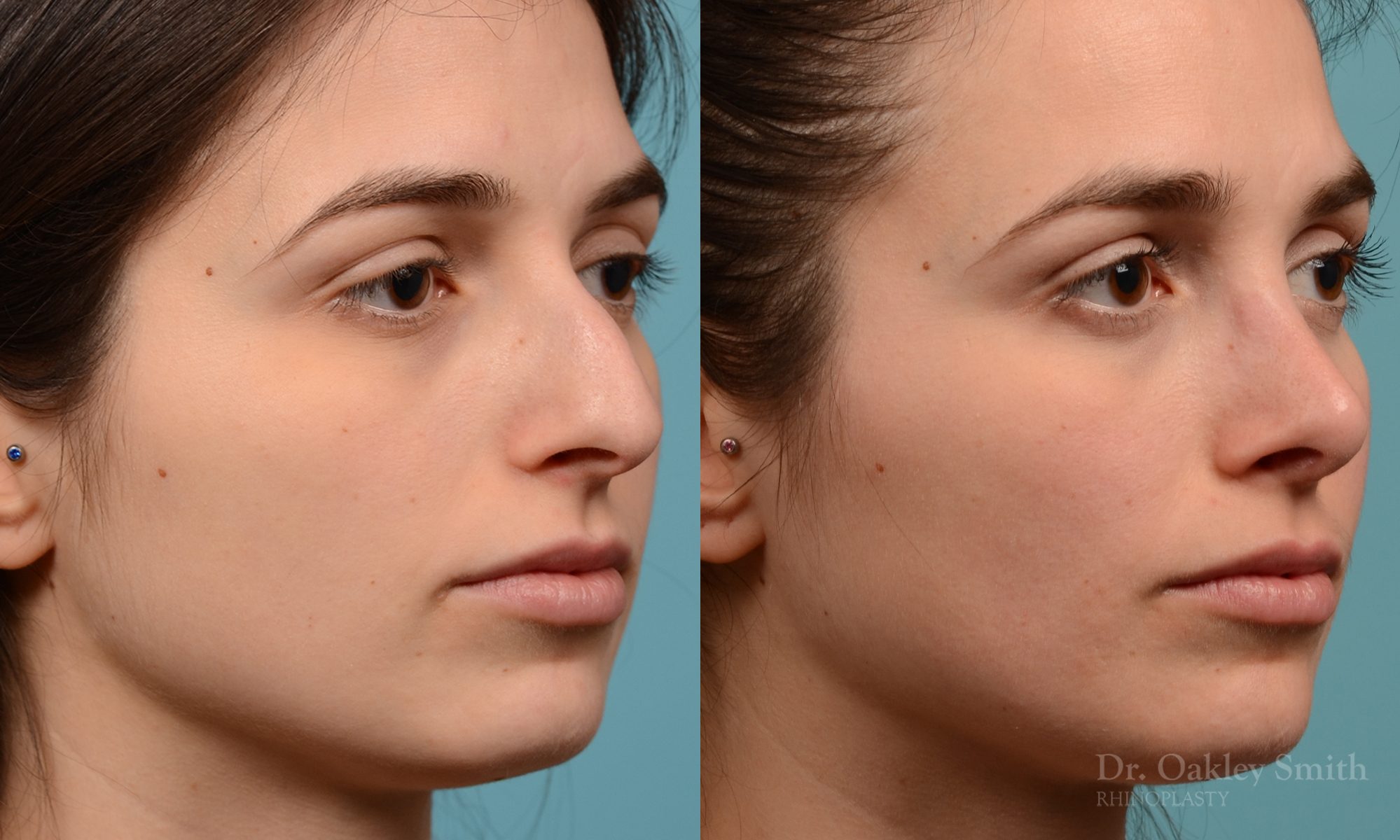 Severe rhinoplasty with hump reduction