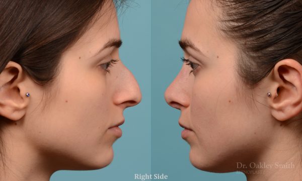 Severe rhinoplasty with hump reduction
