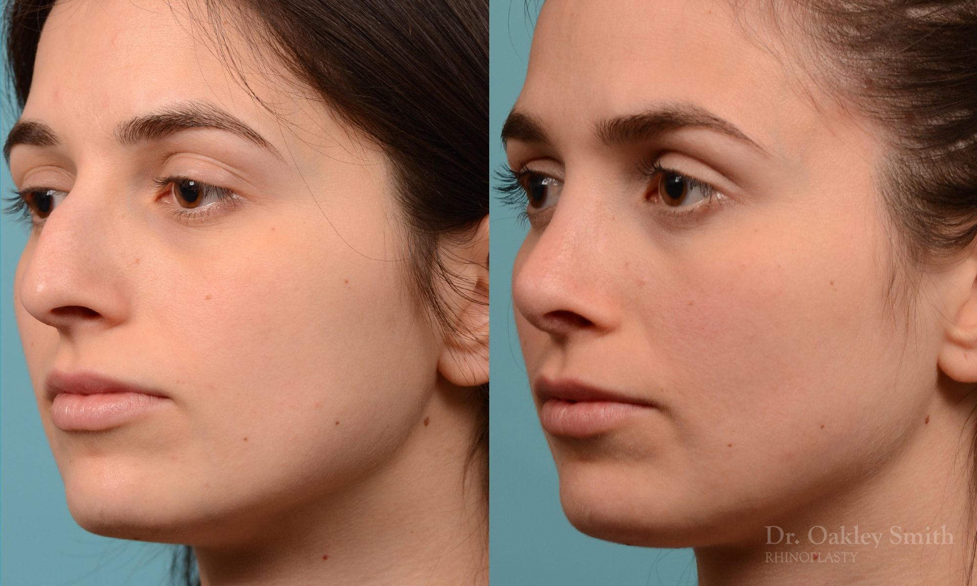 Severe rhinoplasty with hump reduction