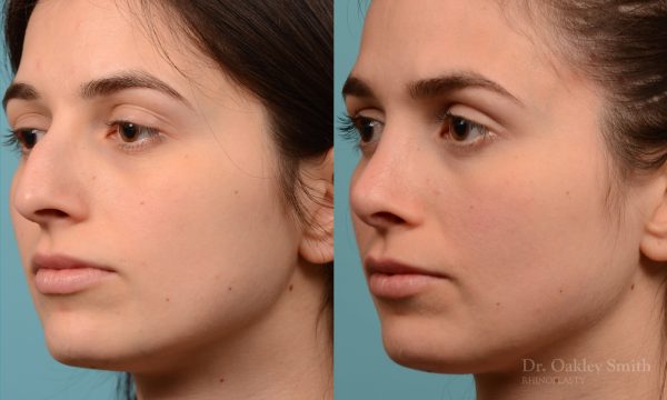 Severe rhinoplasty with hump reduction