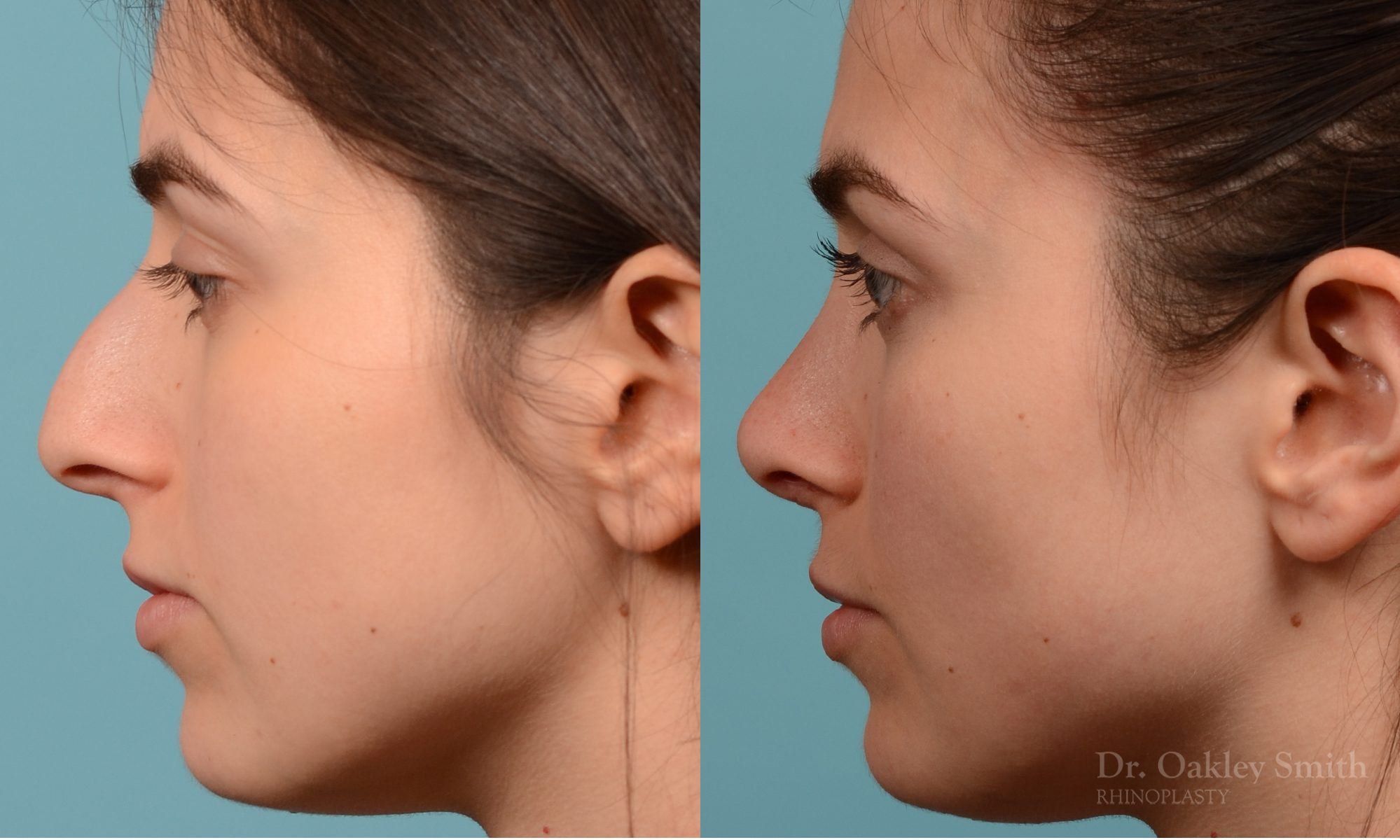 Severe rhinoplasty with hump reduction